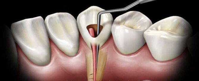 عصب کشی دندان