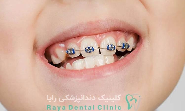 ارتودنسی دندان