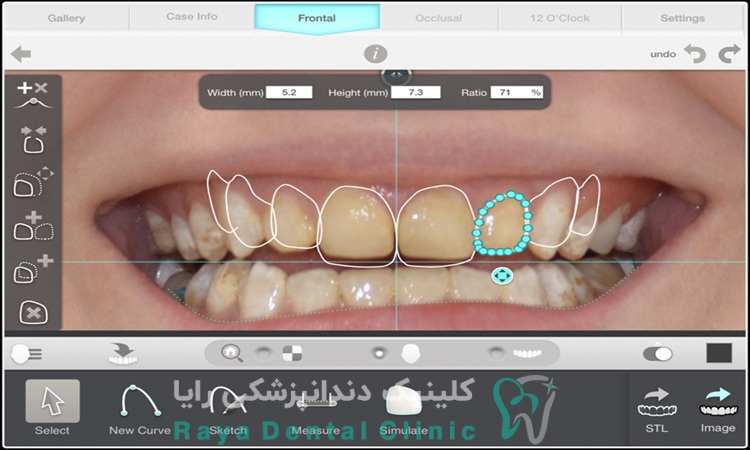 طراحی لبخند دیجیتال چیست و