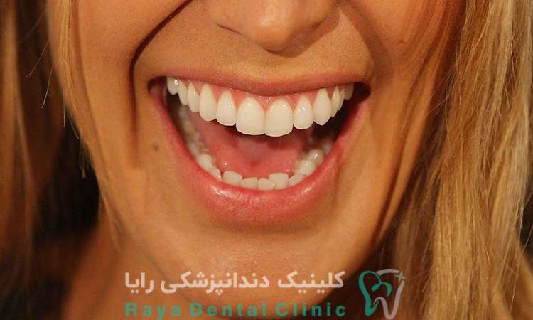 روش های مراقبت از کامپوزیت