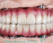 ایمپلنت دندان نئوژن