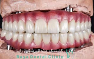 ایمپلنت دندان نئوژن