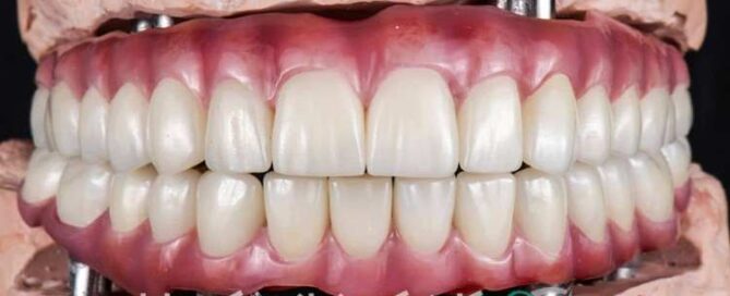 ایمپلنت دندان نئوژن