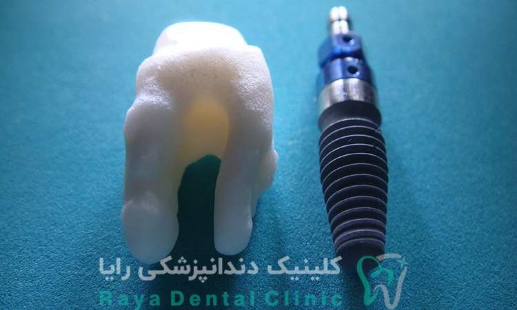 انتخاب ایمپلنت نئوژن