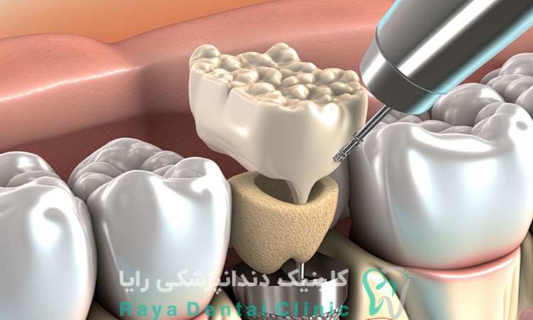 معرفی ایمپلنت نئوژن