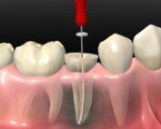 تفاوت ترمیم موقت و تاج دائمی