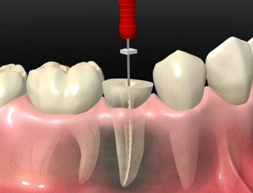 تفاوت ترمیم موقت و تاج دائمی بعد از عصب کشی