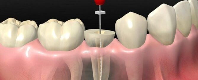 تفاوت ترمیم موقت و تاج دائمی