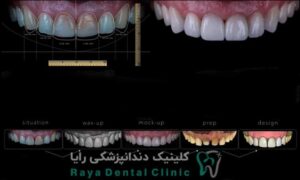 طراحی حرفه ای لبخند