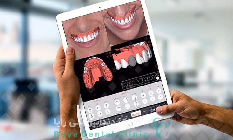 روش سنتی در طراحی لبخند