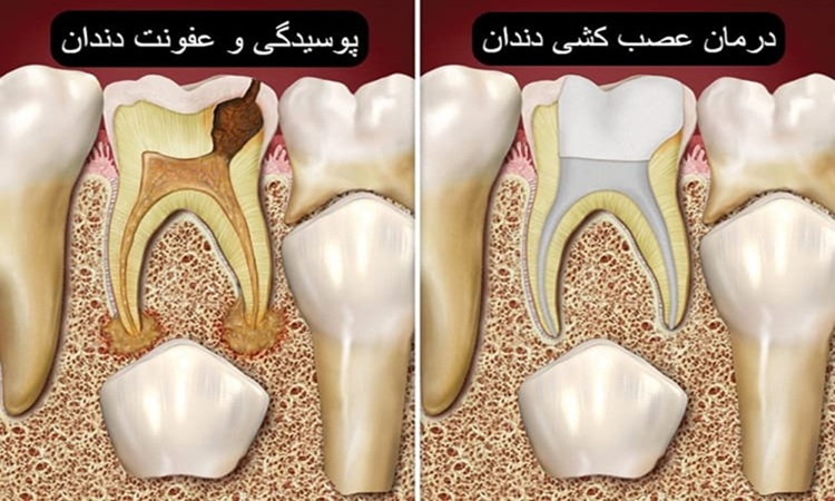 عصب کشی دندان های آسیاب