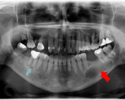 عصب کشی دندان