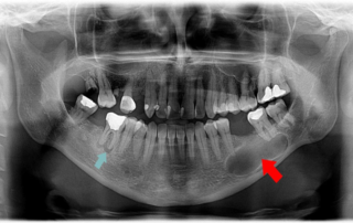 عصب کشی دندان