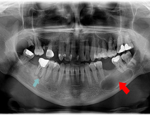 چه دندان هایی بیشترین نیاز به عصب کشی دارند؟