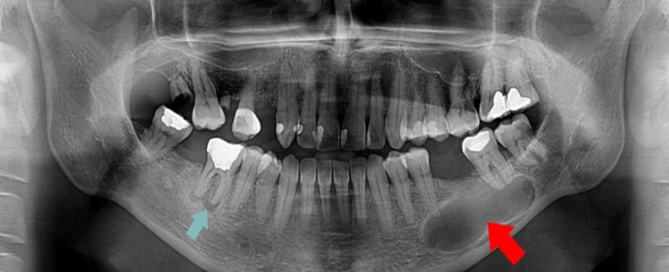 عصب کشی دندان