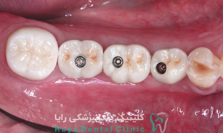 ایمپلنت در نواحی مختلف دهان