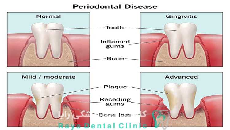 مهم ترین علل تحلیل لثه