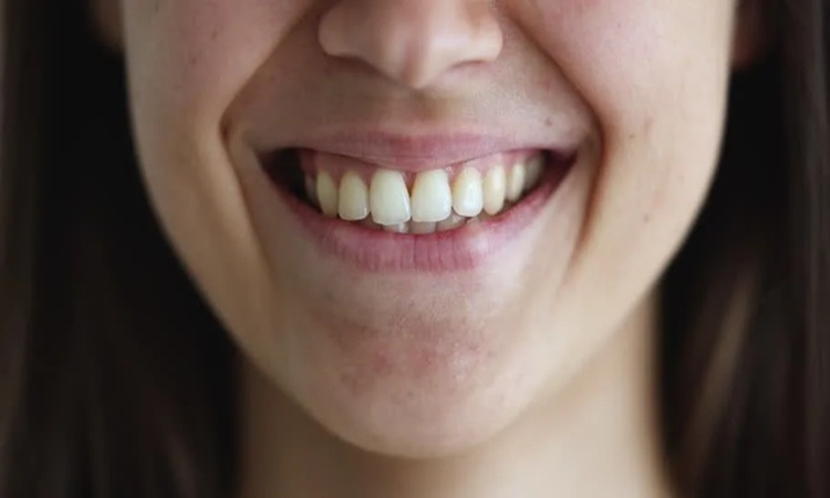 تاثیر تقارن صورت بر جذابیت لبخند