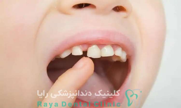 اهمیت دندان های شیری