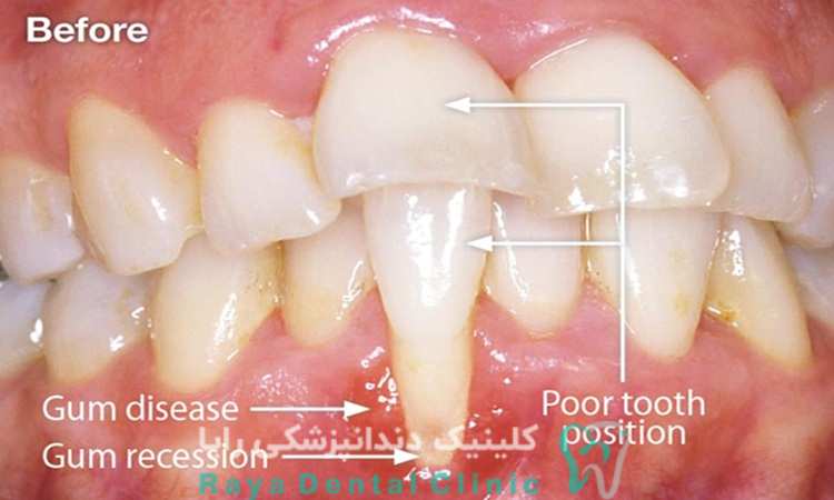 پیشگیری از عقب رفتن لثه