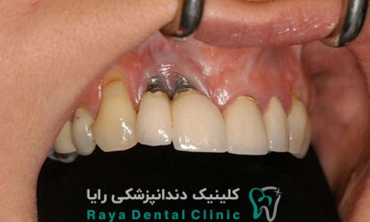 راهکار کاهش حساسیت دندان