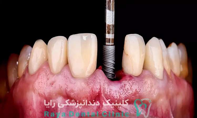 تاثیر ایمپلنت بر دندان