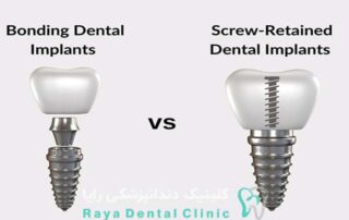 ایمپلنت دندان جلویی