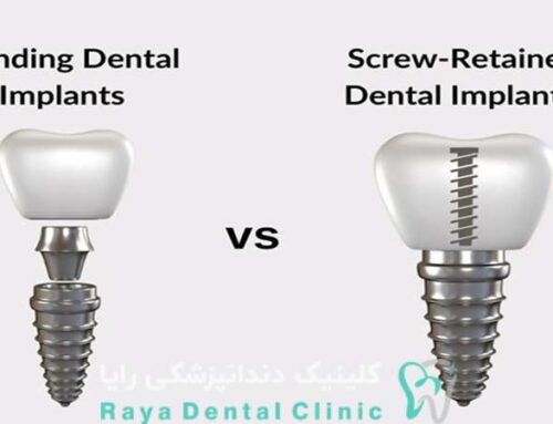 ایمپلنت برای دندان های جلویی بهتر است یا آسیاب؟