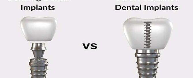 ایمپلنت دندان جلویی