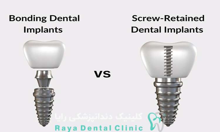 ایمپلنت دندان جلویی