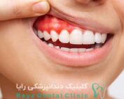 حساسیت دندان های مجاور