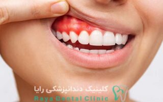 حساسیت دندان های مجاور