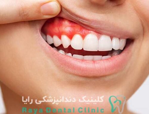 آیا ایمپلنت باعث حساسیت دندان های مجاور می شود؟