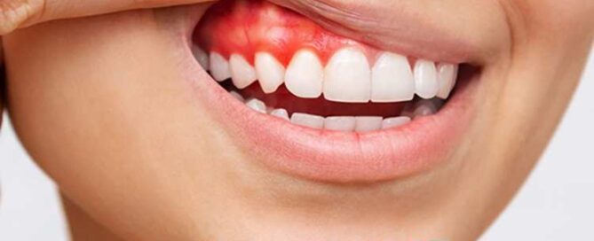 حساسیت دندان های مجاور