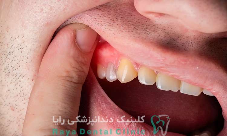 روش های جایگزین دندان