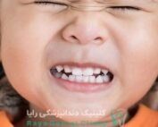 دندان قروچه در کودکان