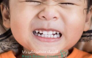 دندان قروچه در کودکان