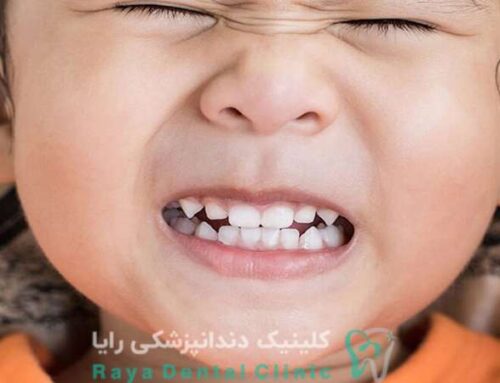 دندان قروچه در کودکان نشانه چیست؟