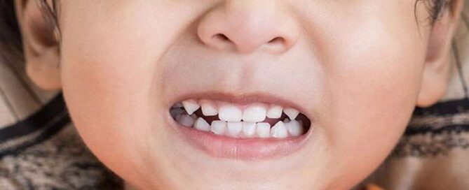 دندان قروچه در کودکان