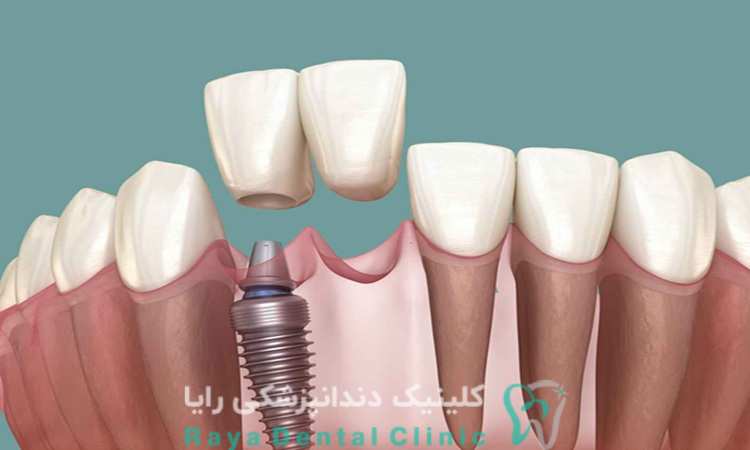 ایمپلنت دندان جلویی و آسیاب