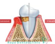 علت عقب رفتن لثه ها