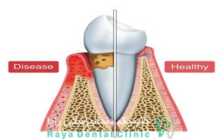 علت عقب رفتن لثه ها