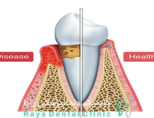 عقب رفتن لثه ها بدون درد نشانه چیست؟