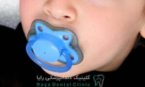 مکیدن پستانک به دندان