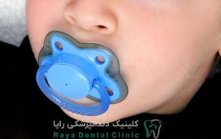 مکیدن پستانک به دندان