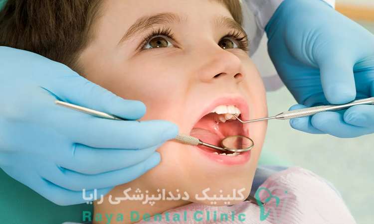 پیامد افتادن دندان شیری