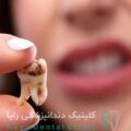 علائم دندان از دست رفته