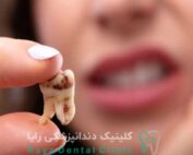 علائم دندان از دست رفته