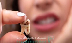 علائم دندان از دست رفته