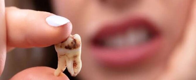 علائم دندان از دست رفته